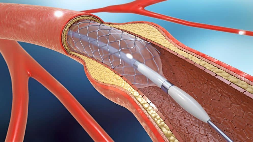 Angioplastia