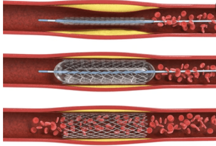 Angioplastia