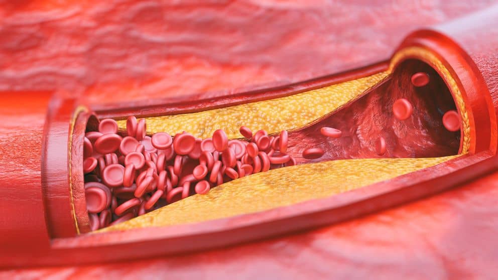 Arterias