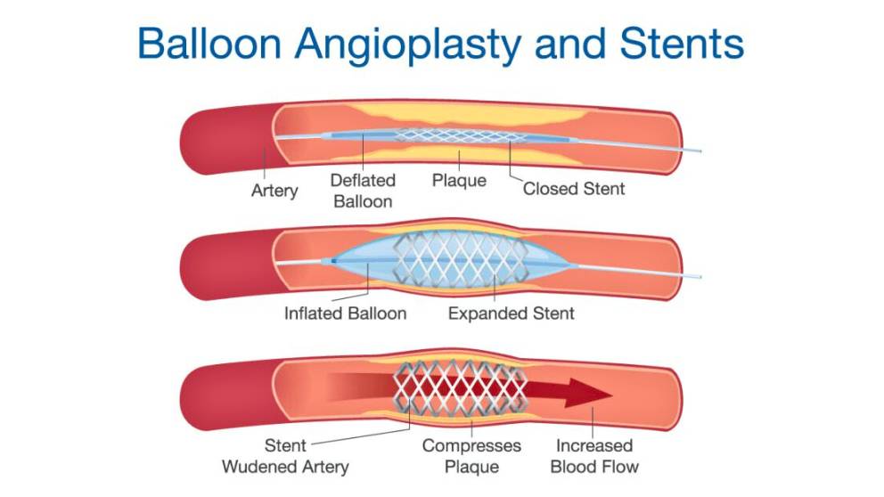 balloon Angioplasty and stents