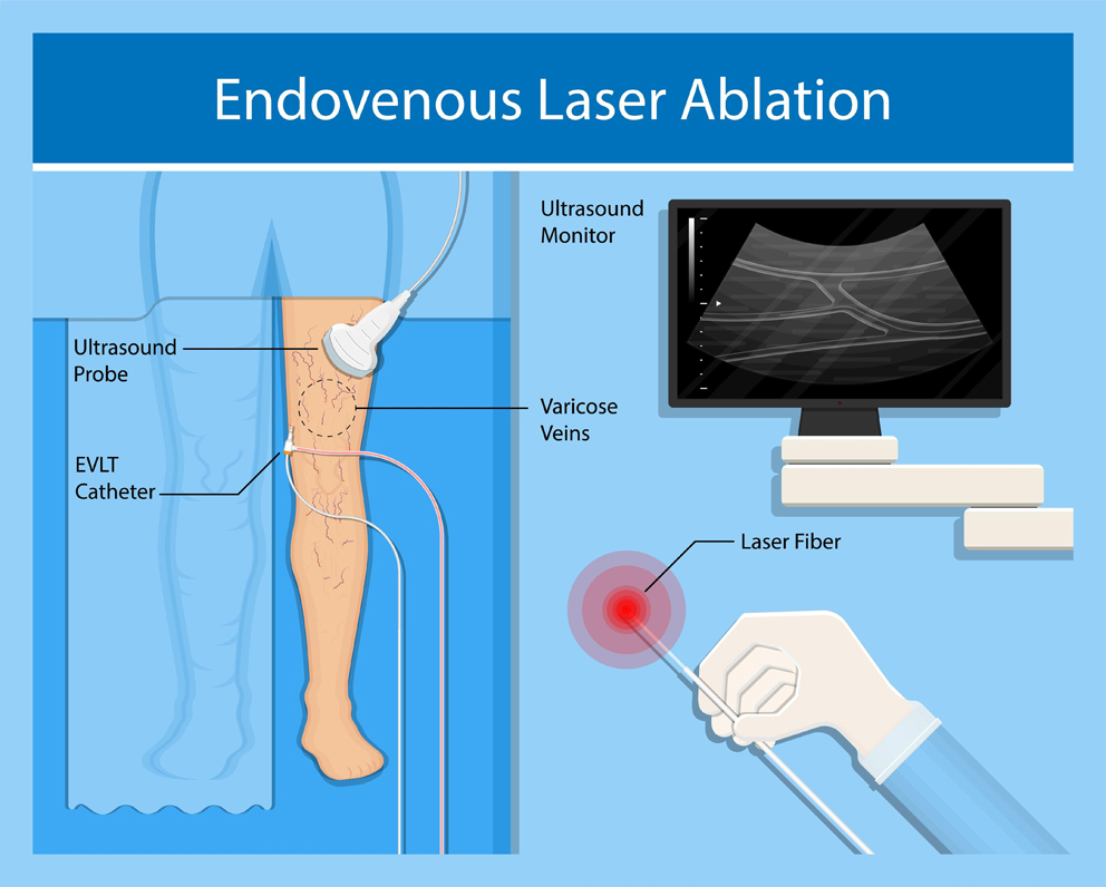 El tratamiento con láser endovenoso (EVLT)