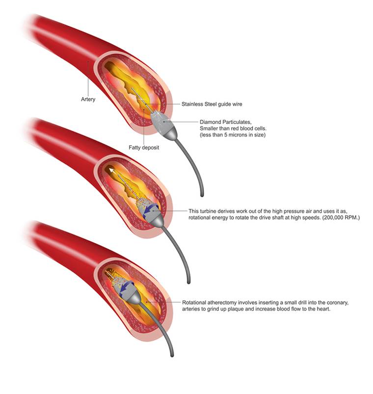 Imaging & Interventional Specialists “Pinhole” Procedures: Fast Recovery, Less Risk, Less Pain, Comfortable Setting