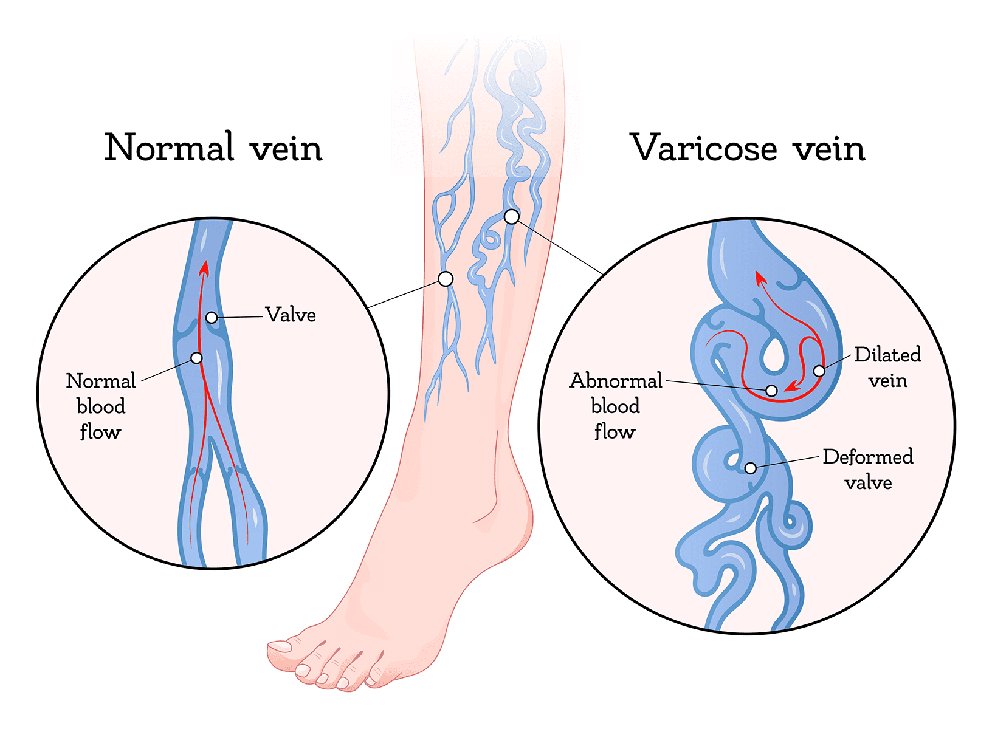 Normal Vein Varicose Vein