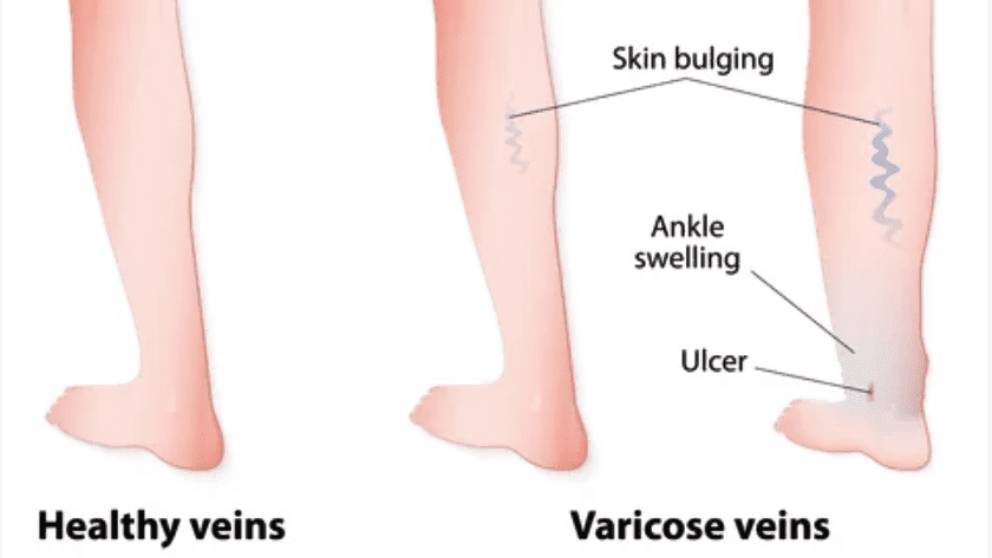 Qué causa las úlceras venosas