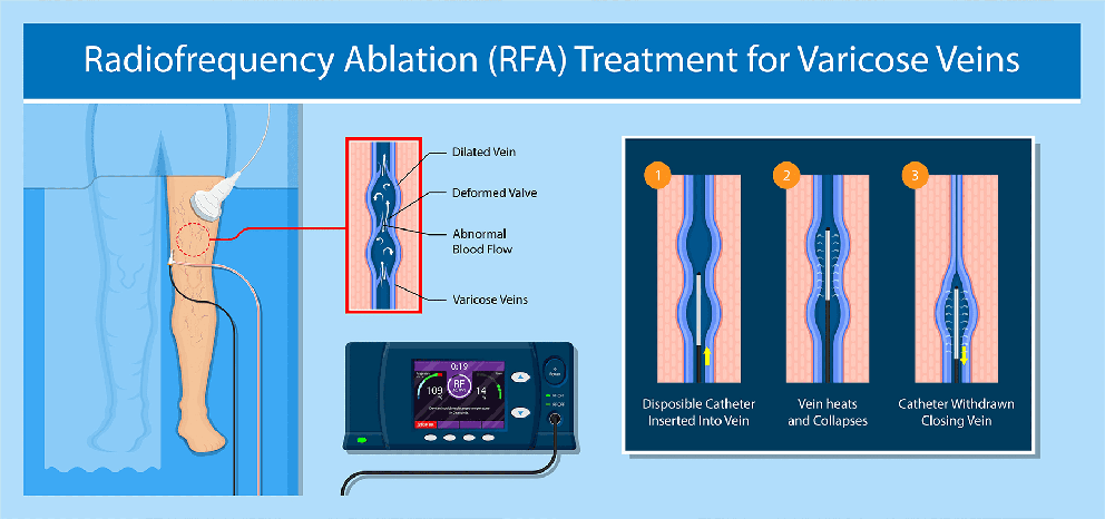 Radiofrequency Ablation