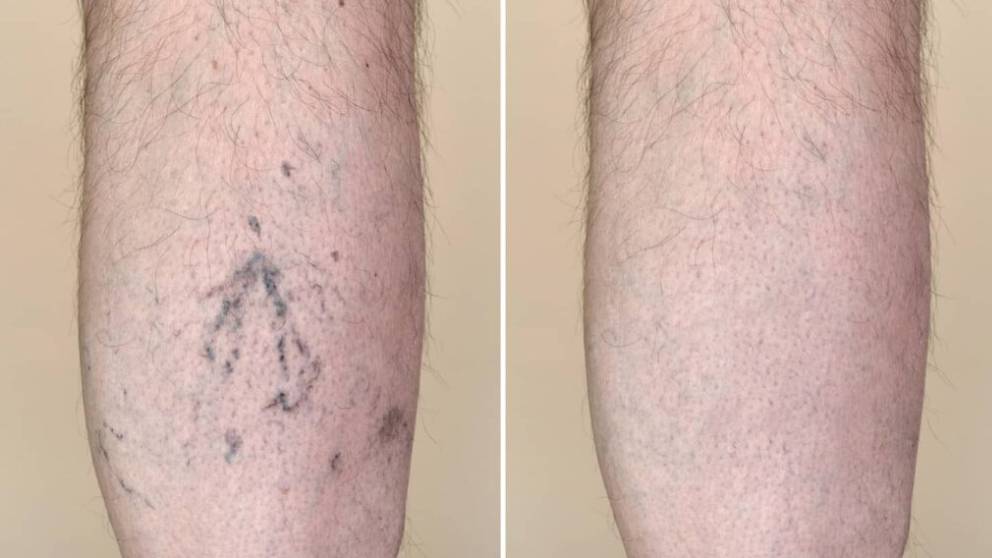 spider veins