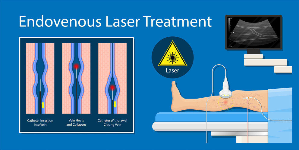 TRATAMIENTO CON LÁSER ENDOVENOSO (EVLT)