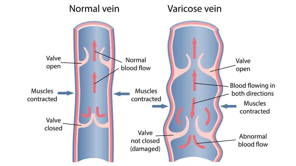 ¿Cómo causa el flujo sanguíneo las venas varicosas?