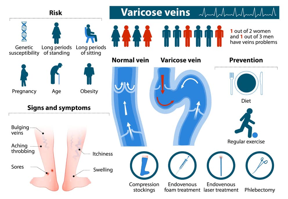 ¿Cuáles son los factores de riesgo para desarrollar venas varicosas?