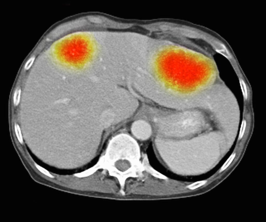 ¿PARA QUÉ TIPOS DE CÁNCER SE UTILIZA LA ABLACIÓN POR MICROONDAS?