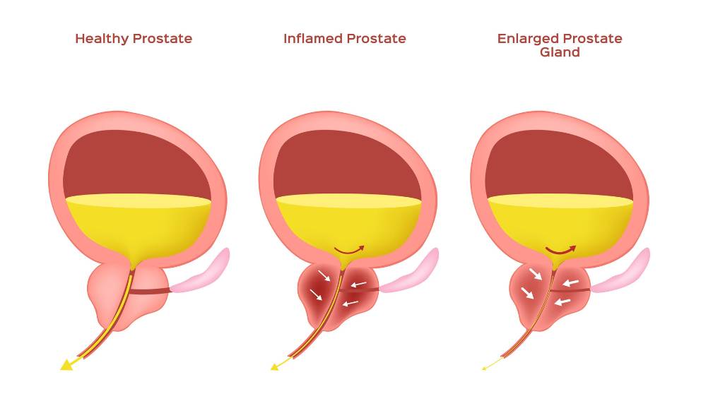 ¿Qué causa un agrandamiento de la próstata/hiperplasia prostática benigna?