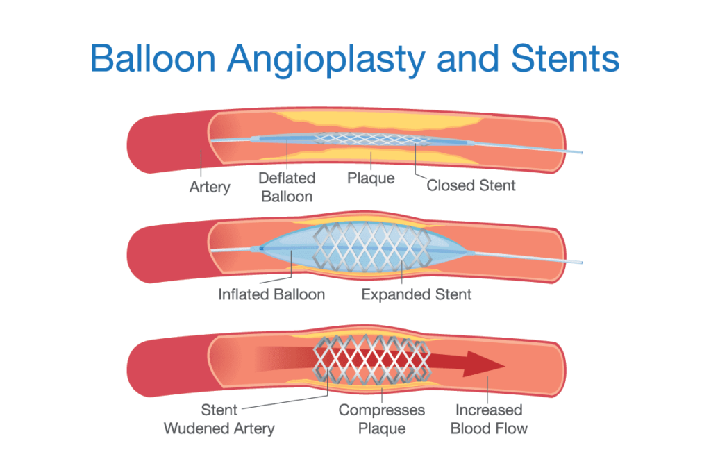 Balloon Angioplasty and Stents