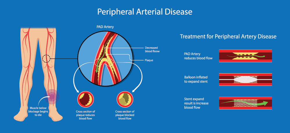 Peripheral Artery Disease