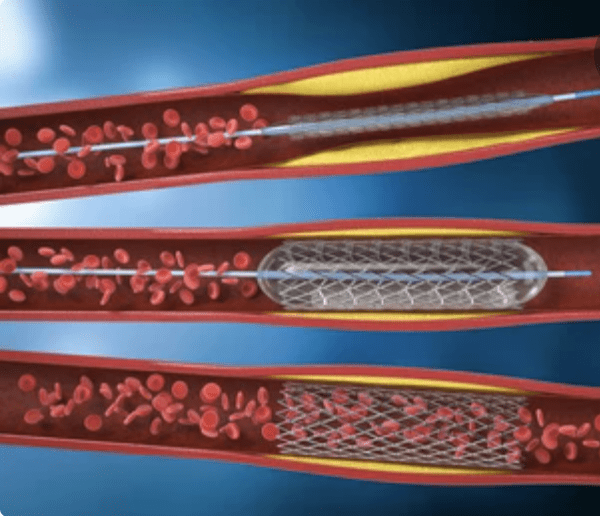 Balloon Angioplasty