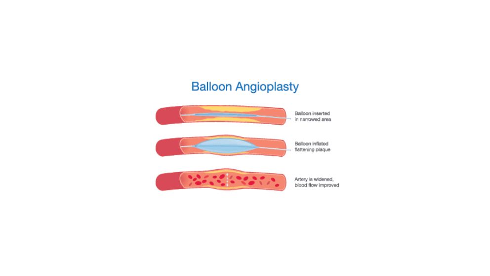 Balloon Angioplasty