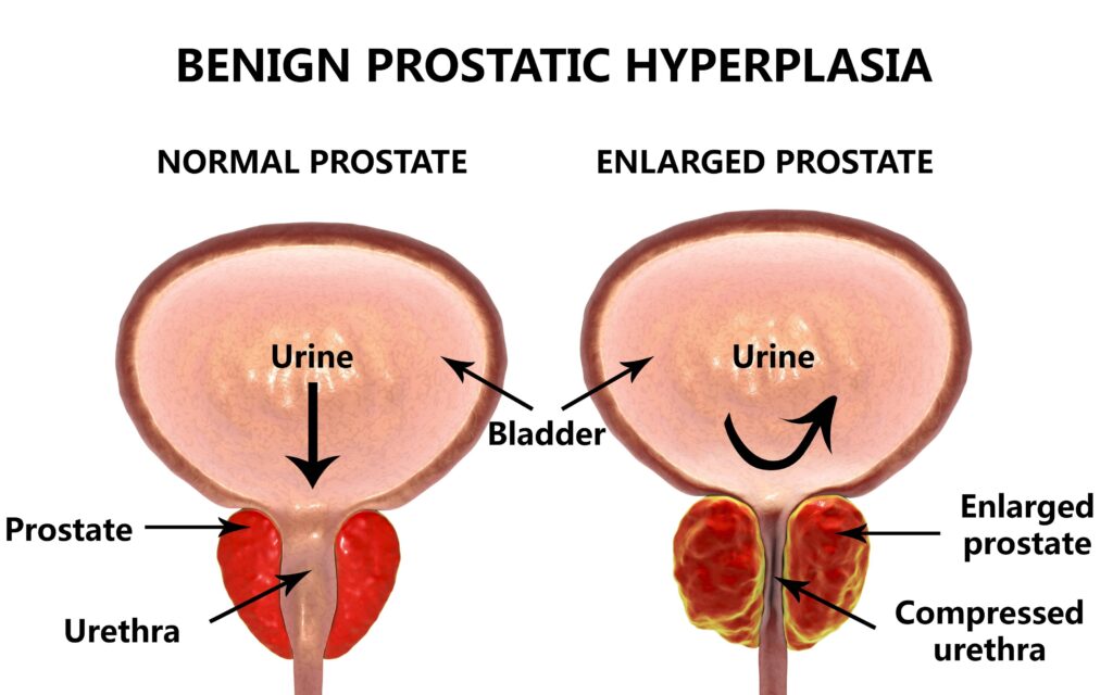 Benign Prostatic Hyperplasia