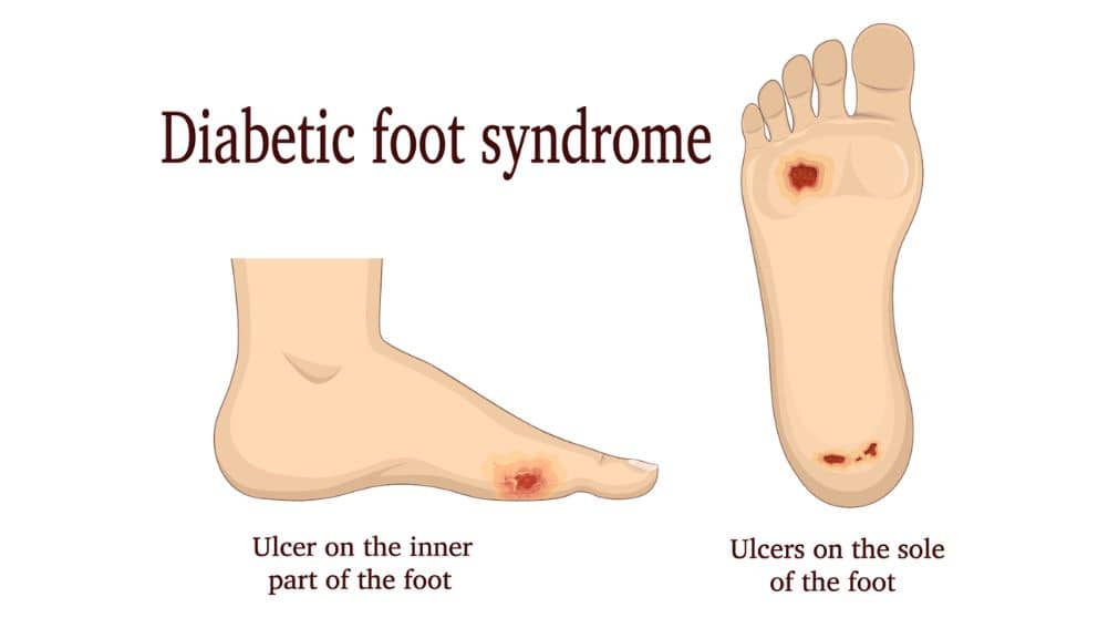 Diabetic Vascular Disease Solution