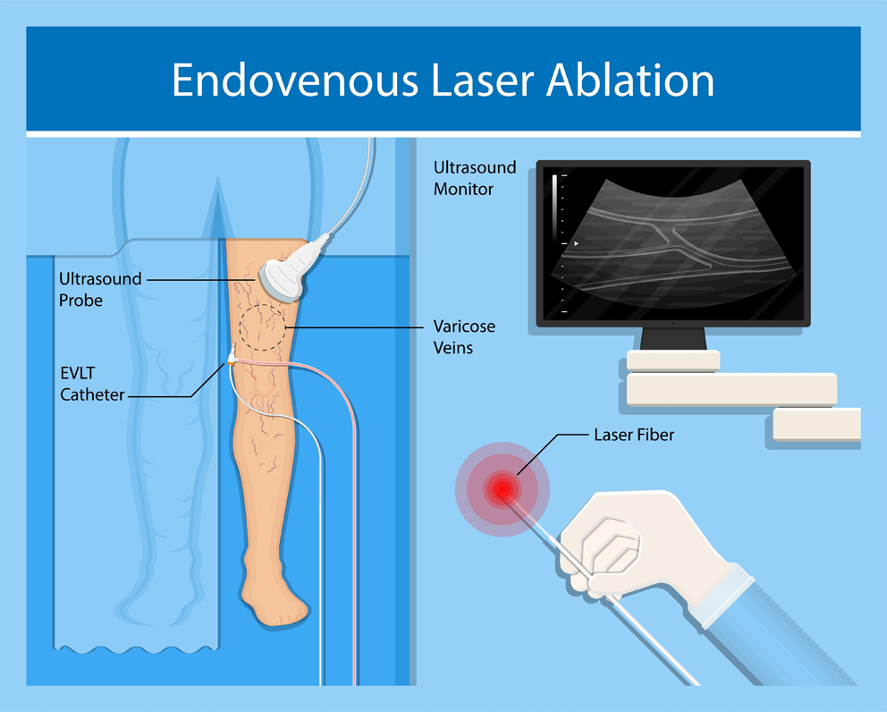 Endovenous Laser Ablation