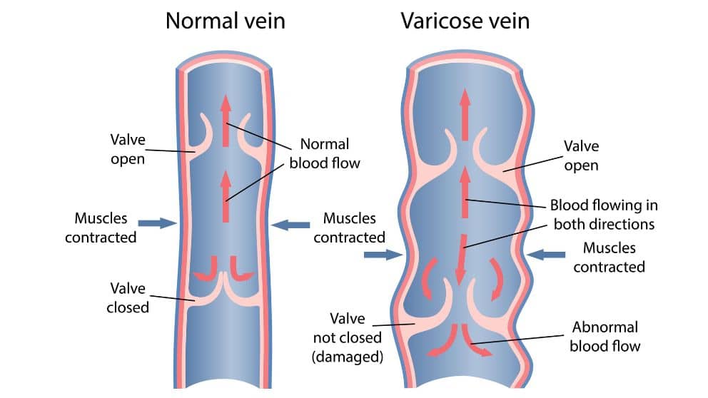How does Blood Flow Cause Varicose Veins?