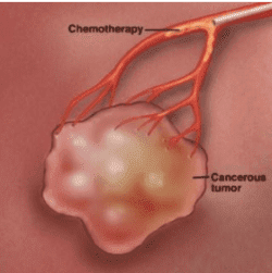 How does chemoembolization work