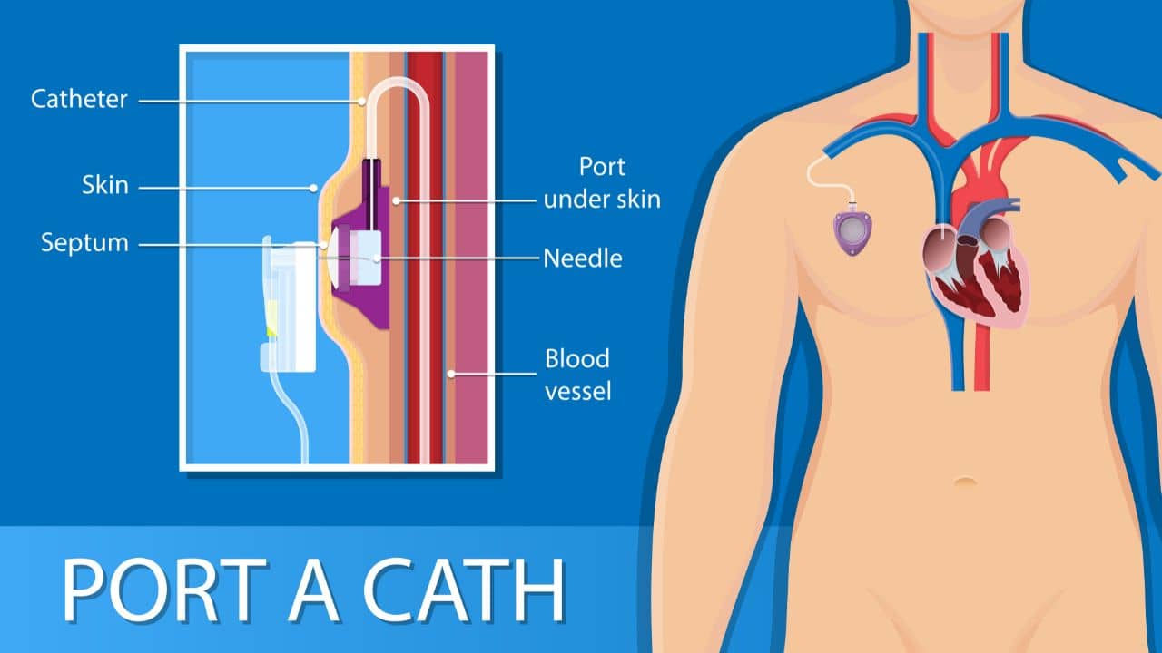 Port a cath imaging and interventional specialists