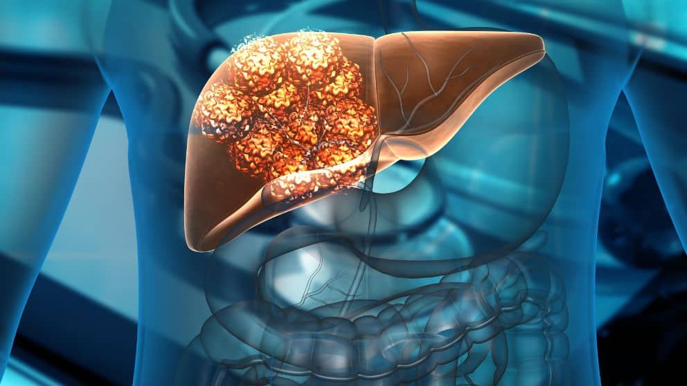 How is Liver Cancer Diagnosed