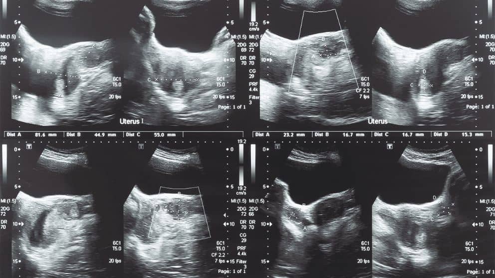 Imaging and Interventional Specialists Find Out Whether You Have Uterine Fibroids