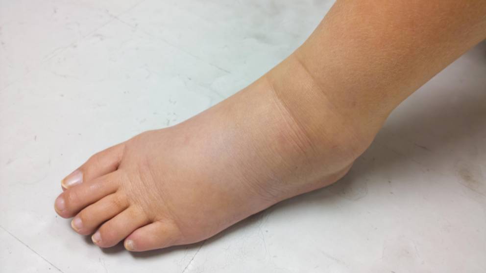 Imaging & Interventional Specialists - Your Leg Swelling Solution