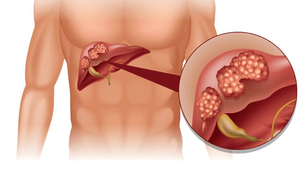 Liver Cancer Solution