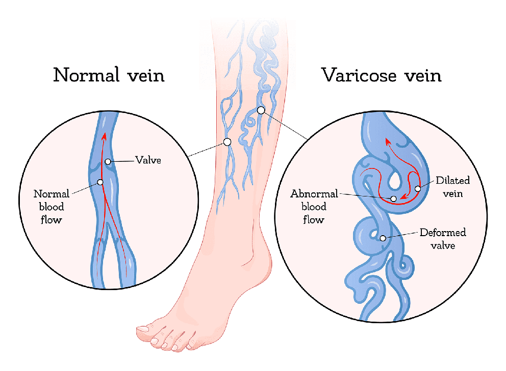 Normal Vein and Varicose Vein
