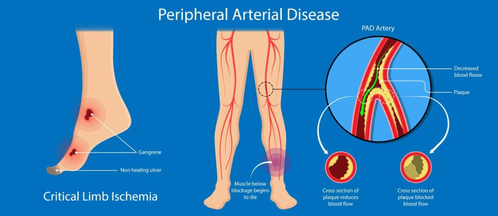 Peripheral Arterial Disease