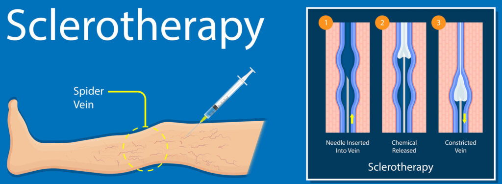 Sclerotherapy