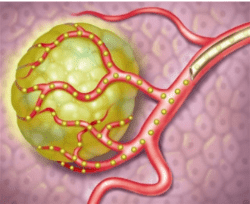 Secondary Liver Cancer