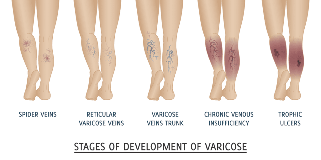 Stages of Development of Varicose