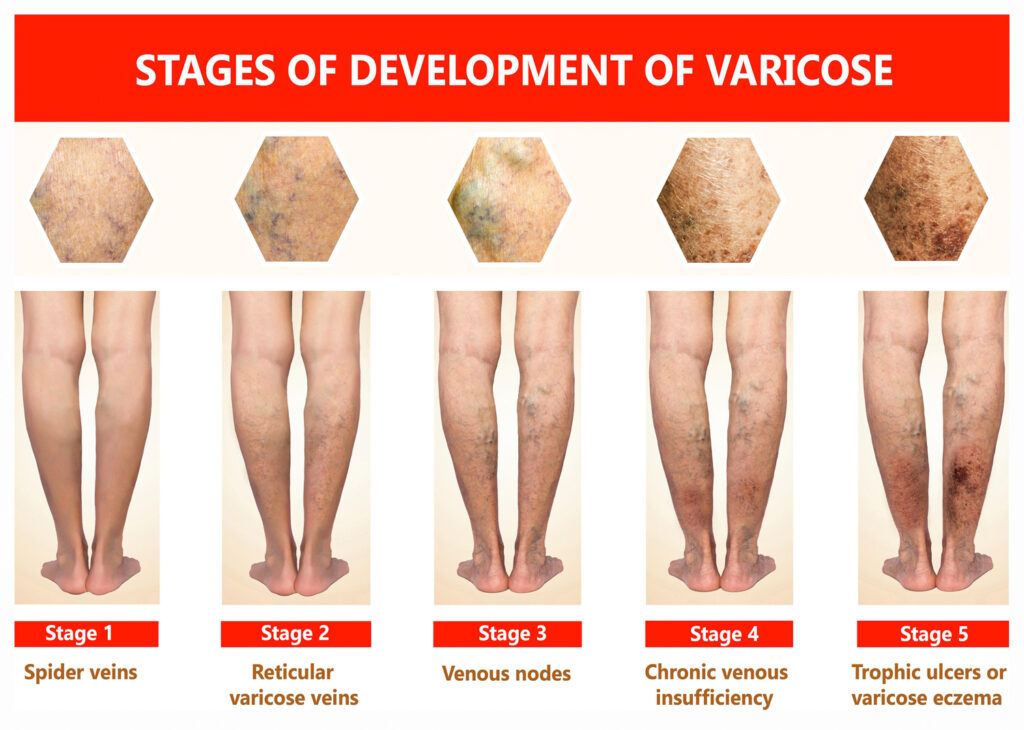 Stages of Development of Varicose