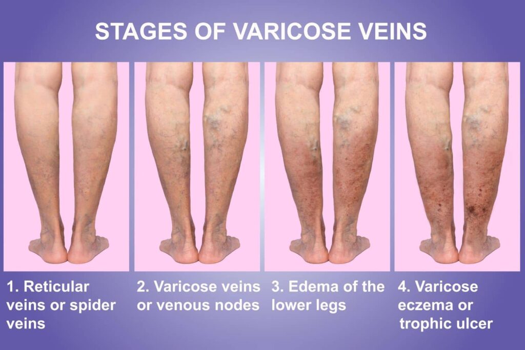 Stages of Varicose Ulcers