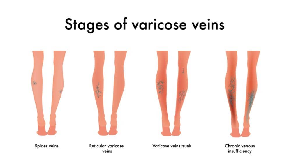Stages of Varicose Veins