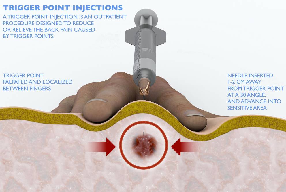 Trigger Points Injections