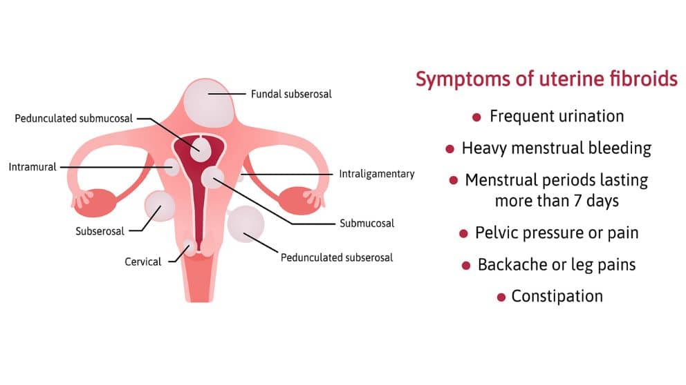 Uterine Fibroids and How Are They Caused