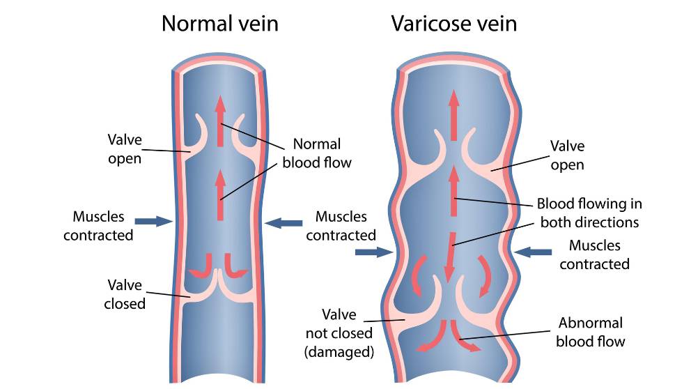 What are the Self-Care Measures You Can Do for Venous Ulcers?