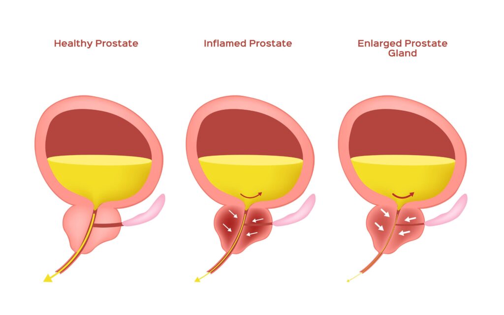 What Causes an Enlarged Prostate/Benign Prostatic Hyperplasia?