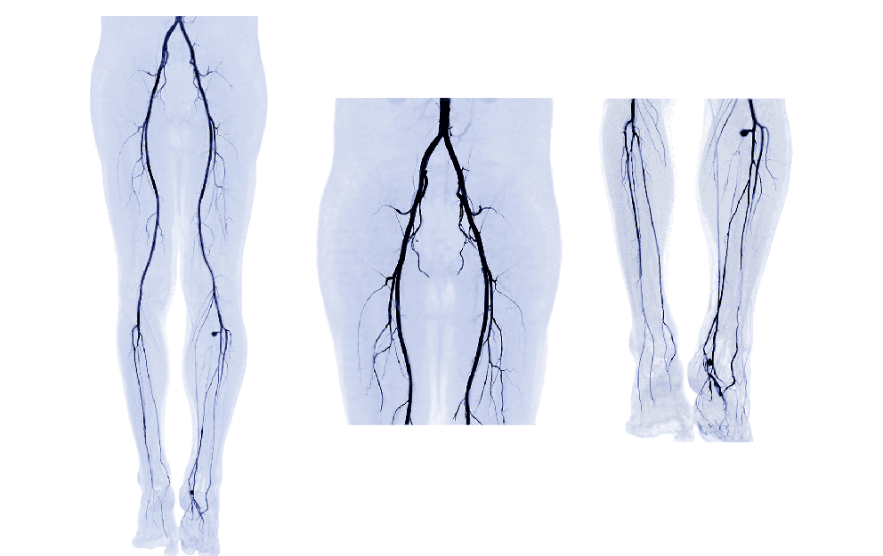 What is Angiography