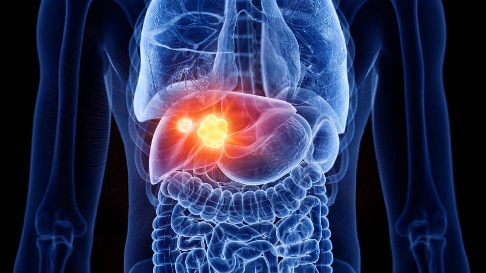 What is Liver Cancer