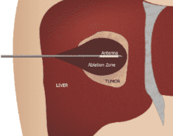 What is thermal ablation