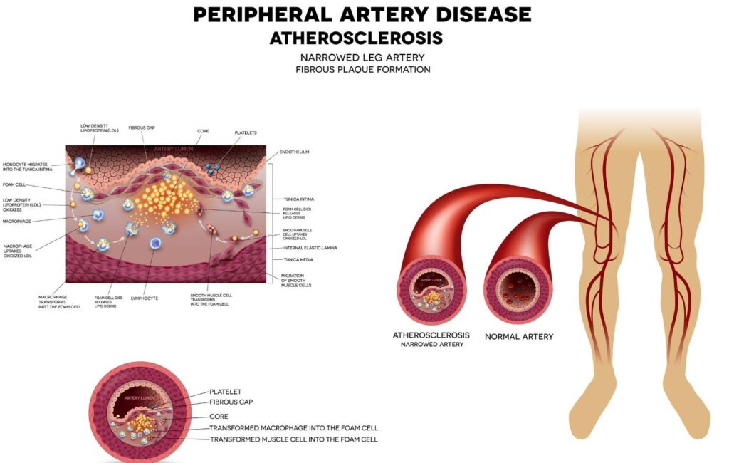 Peripheral Arterial Disease