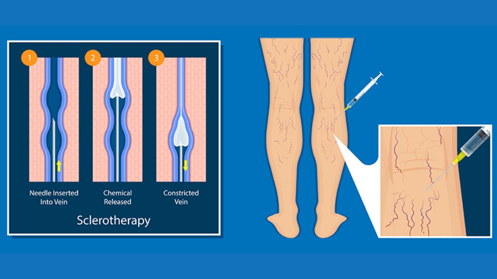 Sclerotherapy